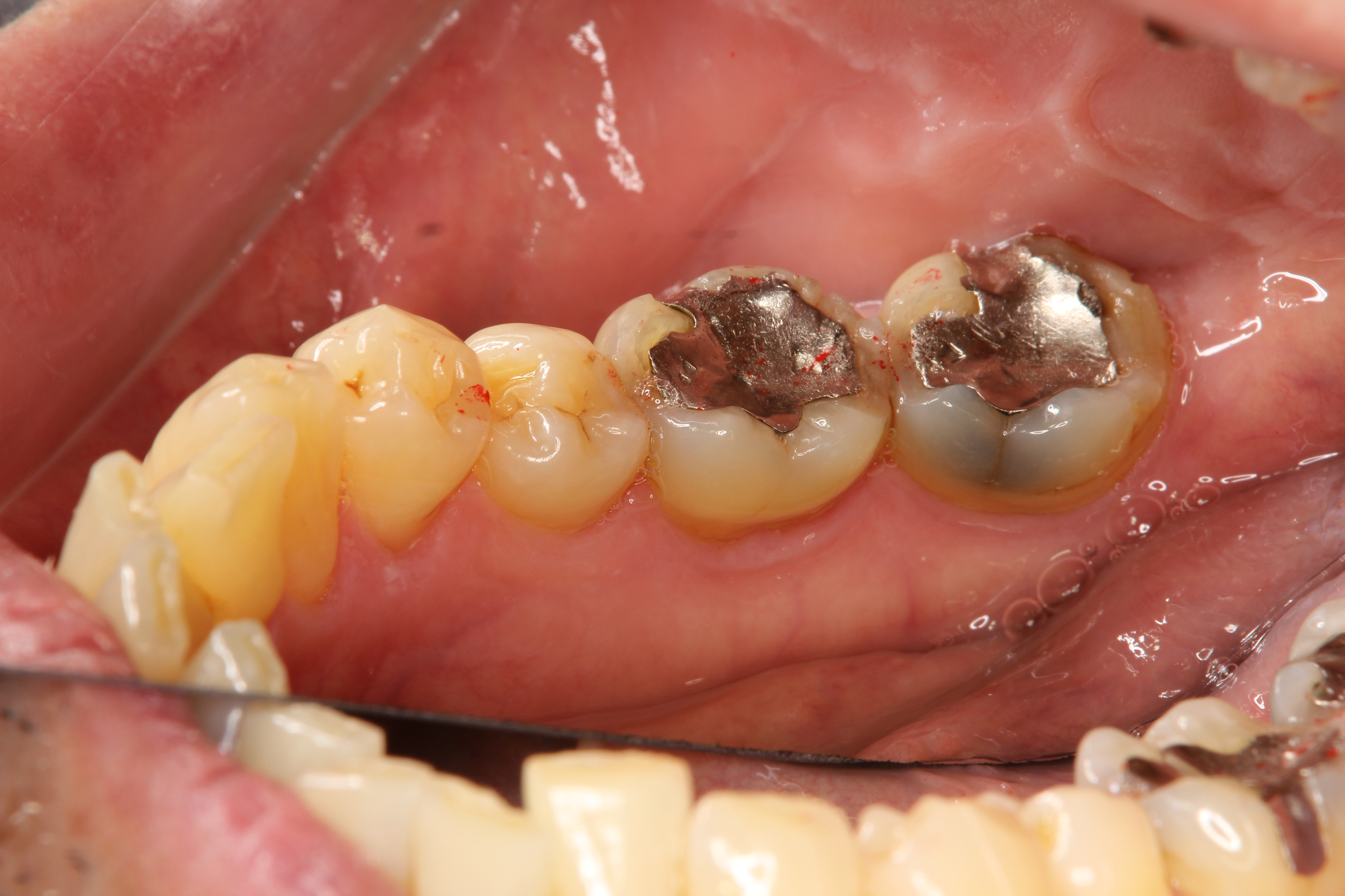 歯 と 歯 の 間 茶色 虫歯