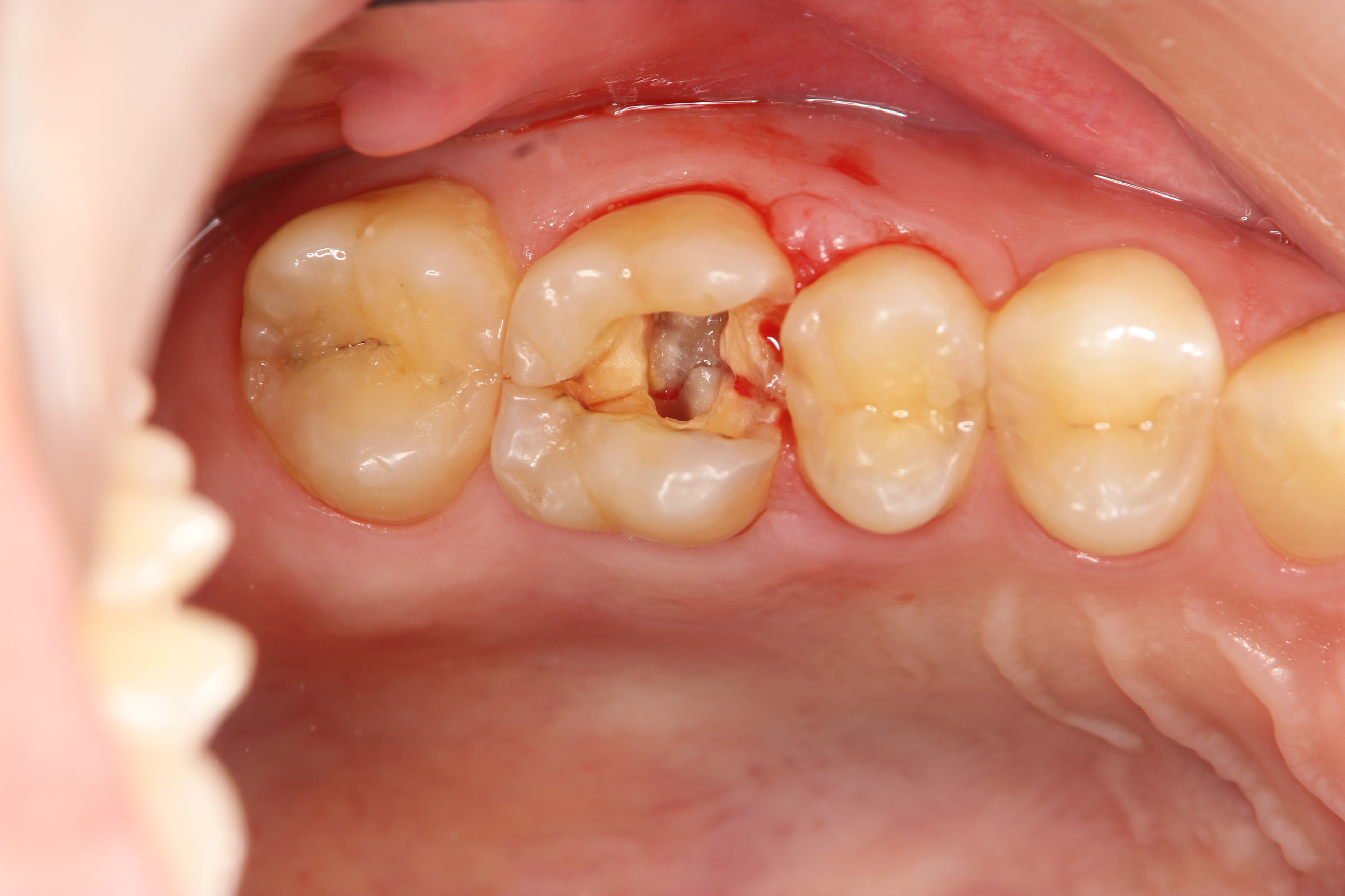 歯 が 根元 から 折れ た 放置
