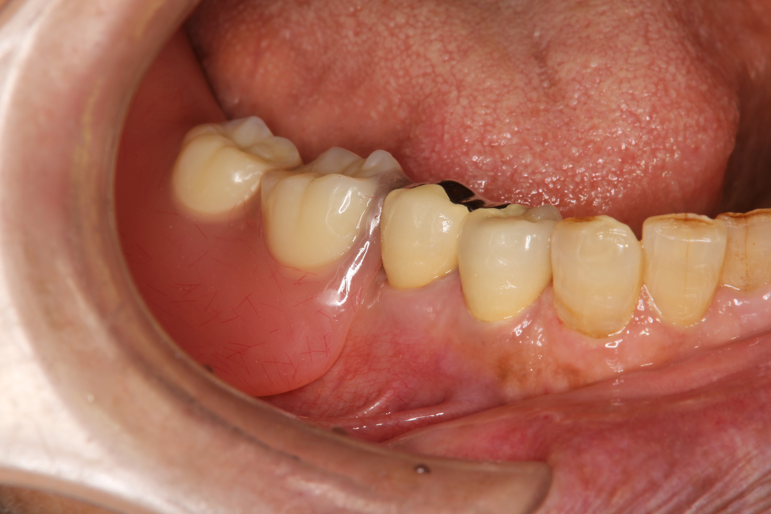 奥歯 折れ た 治療