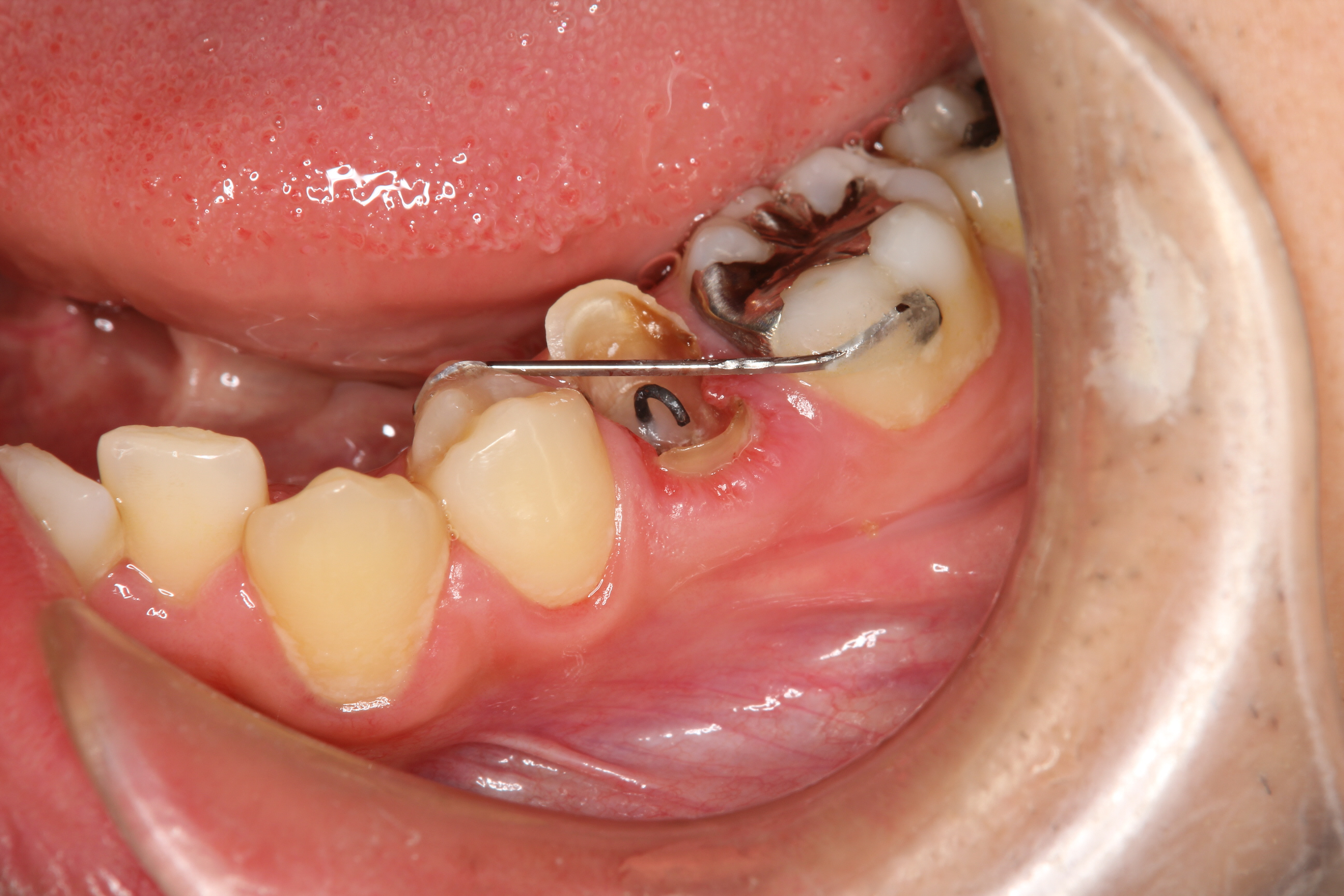 前歯 欠け た 虫歯