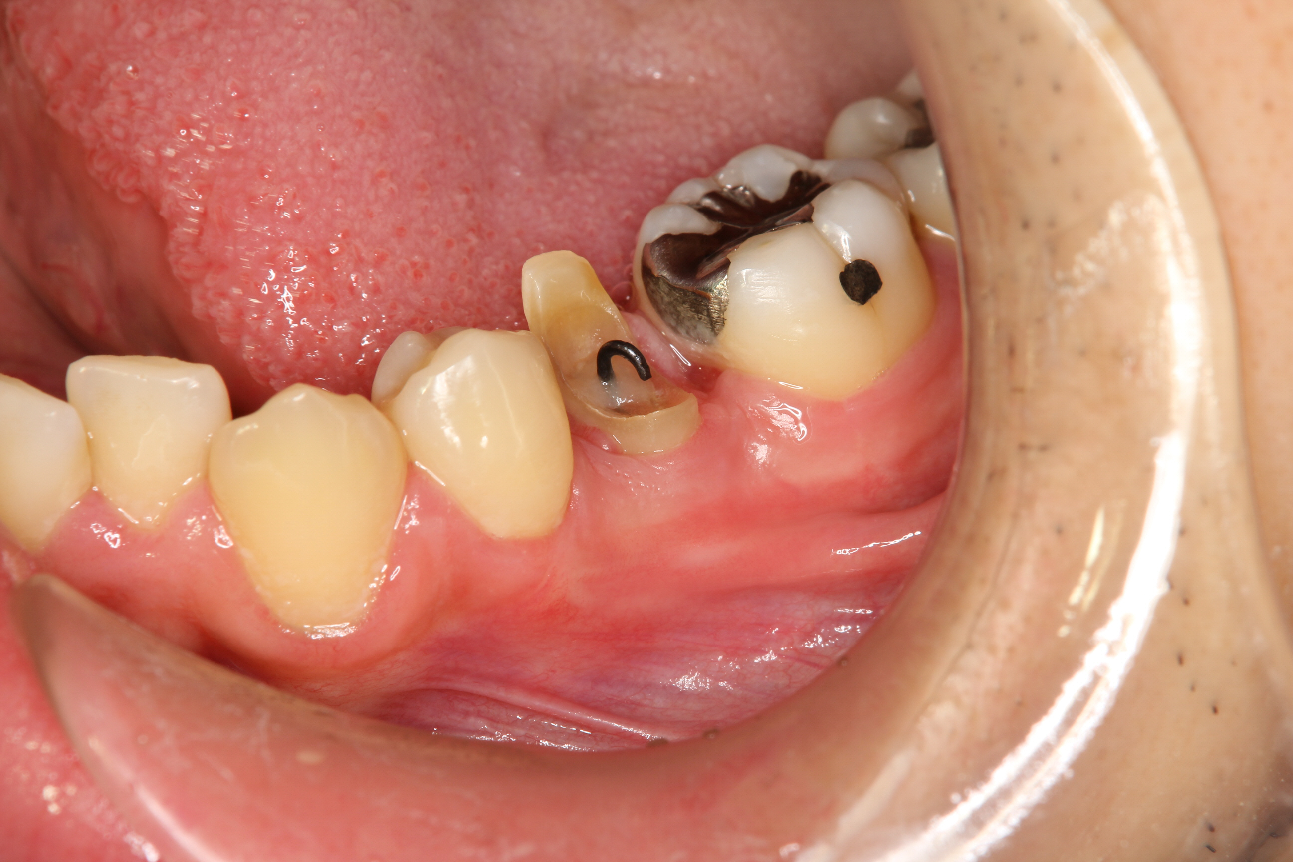 歯医者 に 行 かず に 虫歯 を 治す 方法