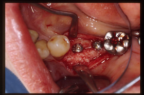 35,36インプラント　自家骨移植(2).jpg