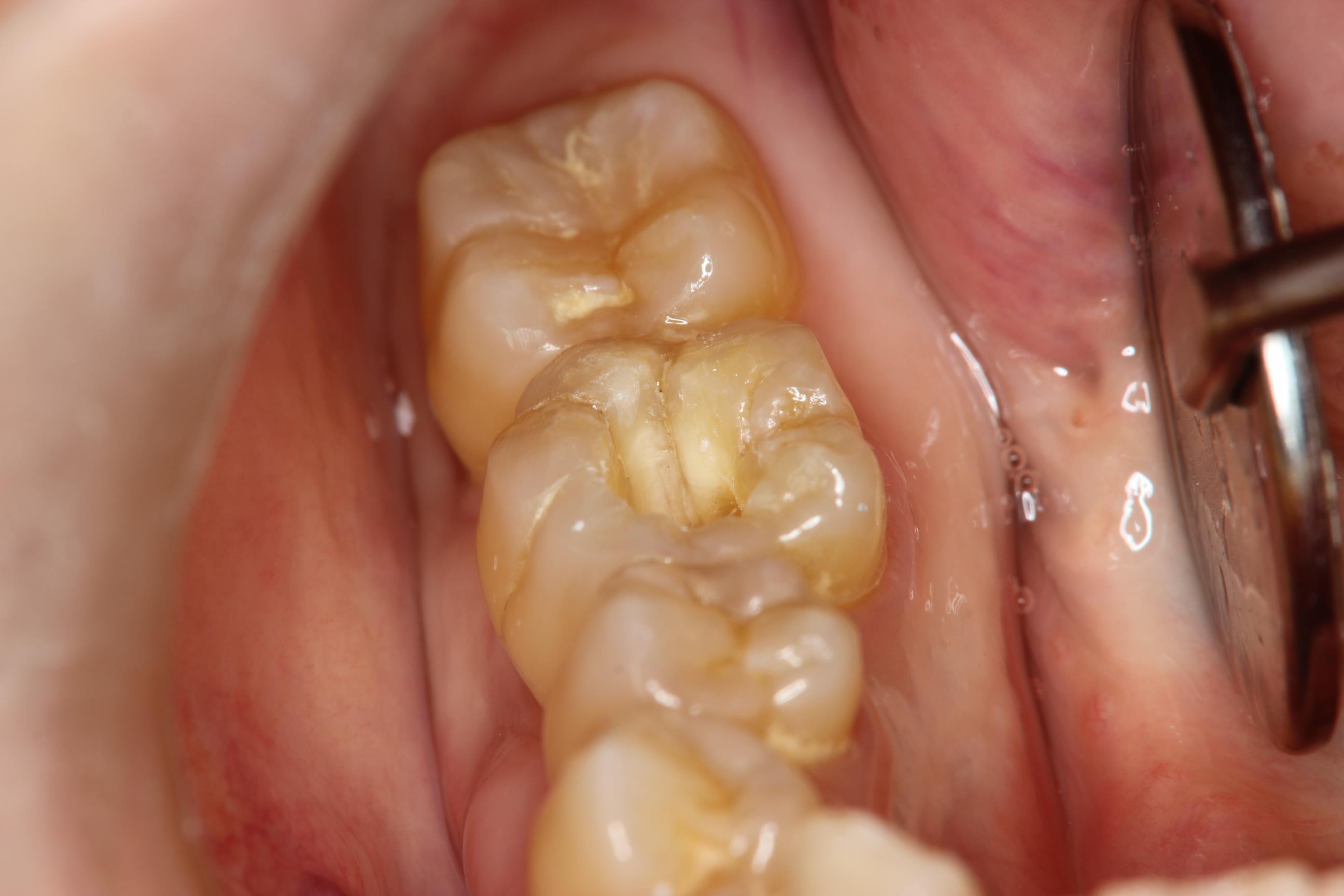 歯茎 の 腫れ