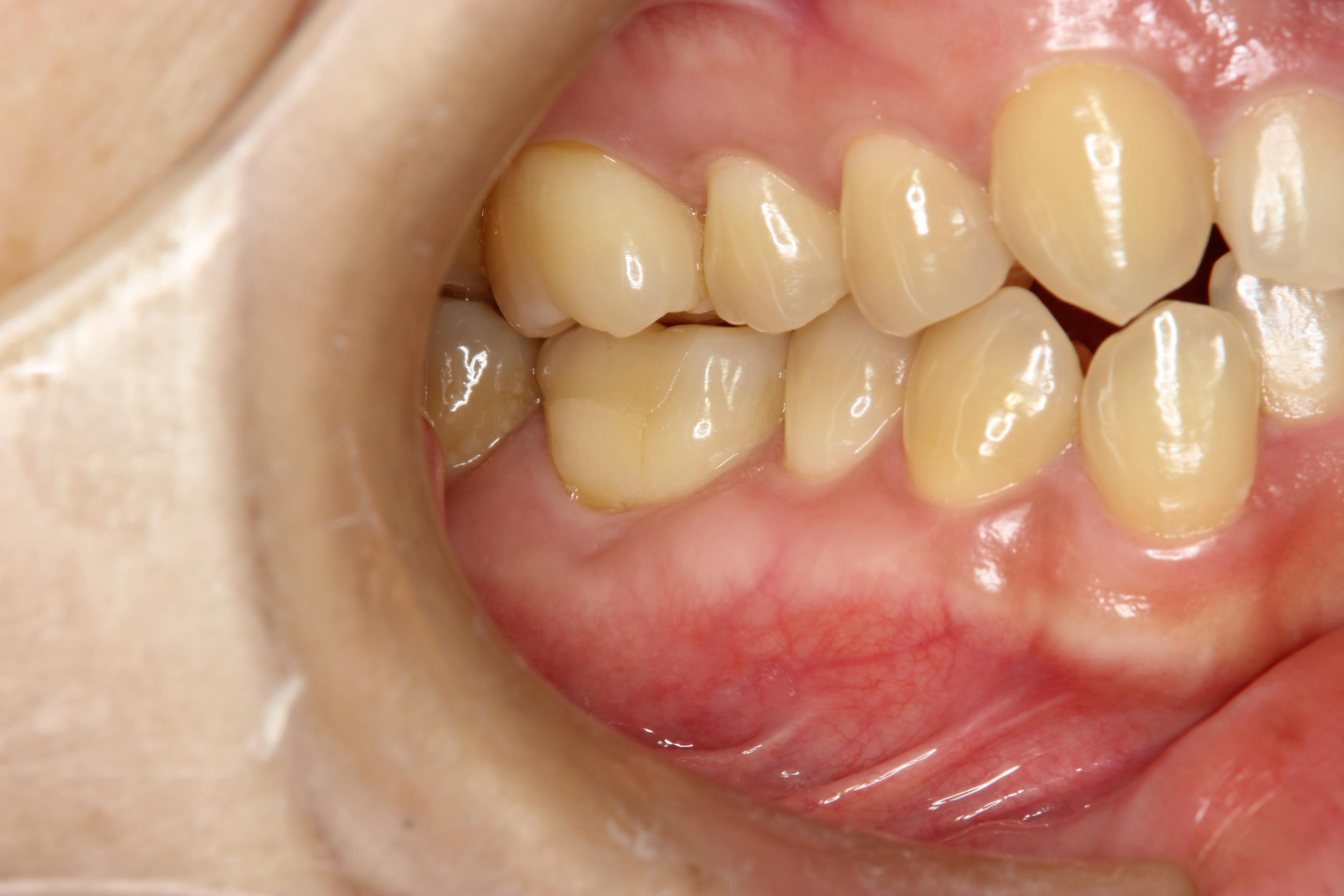 の 腫れ 歯茎 歯茎が腫れる病気と歯周病が原因だったときの対処法
