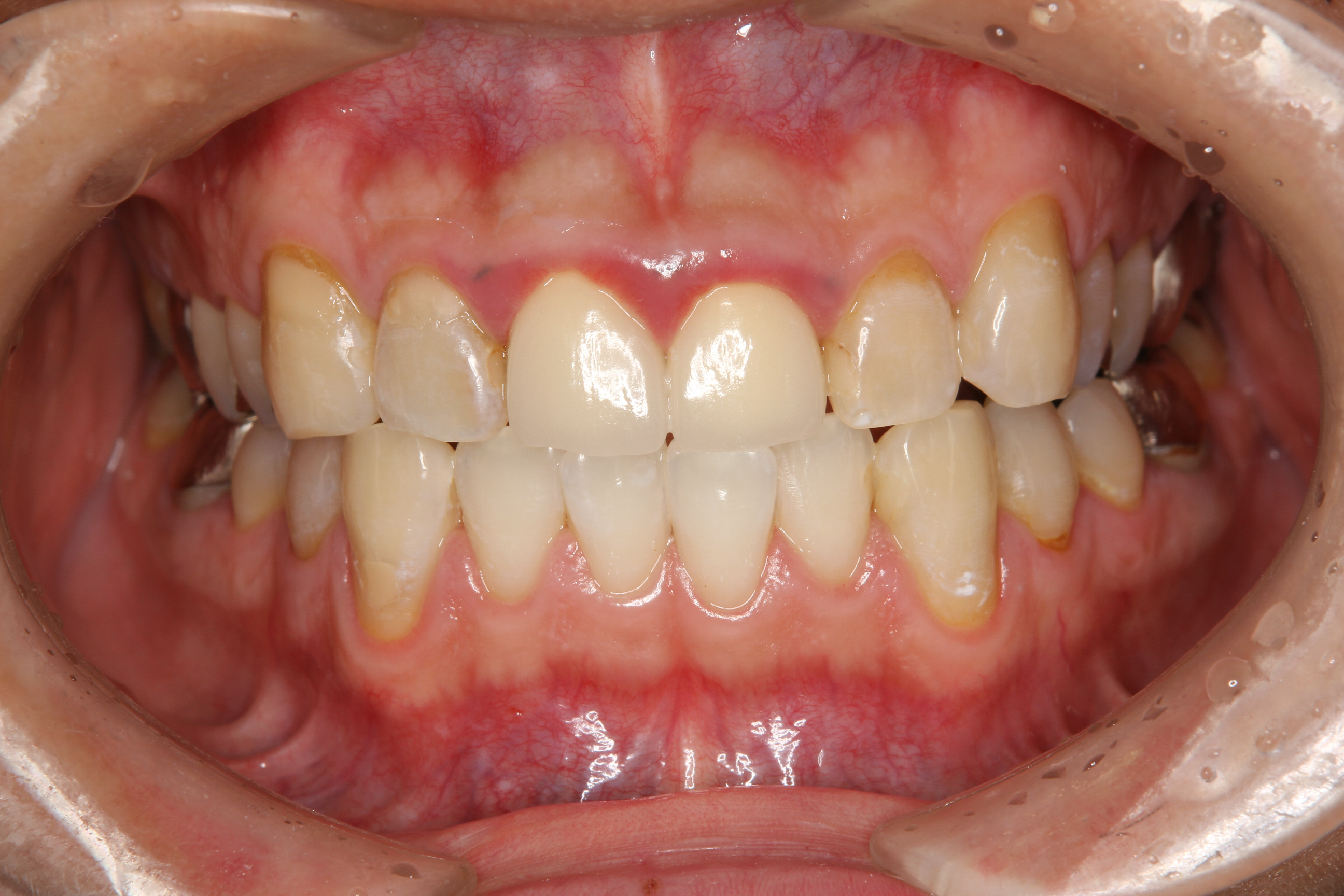 歯茎 の 腫れ 歯肉 炎
