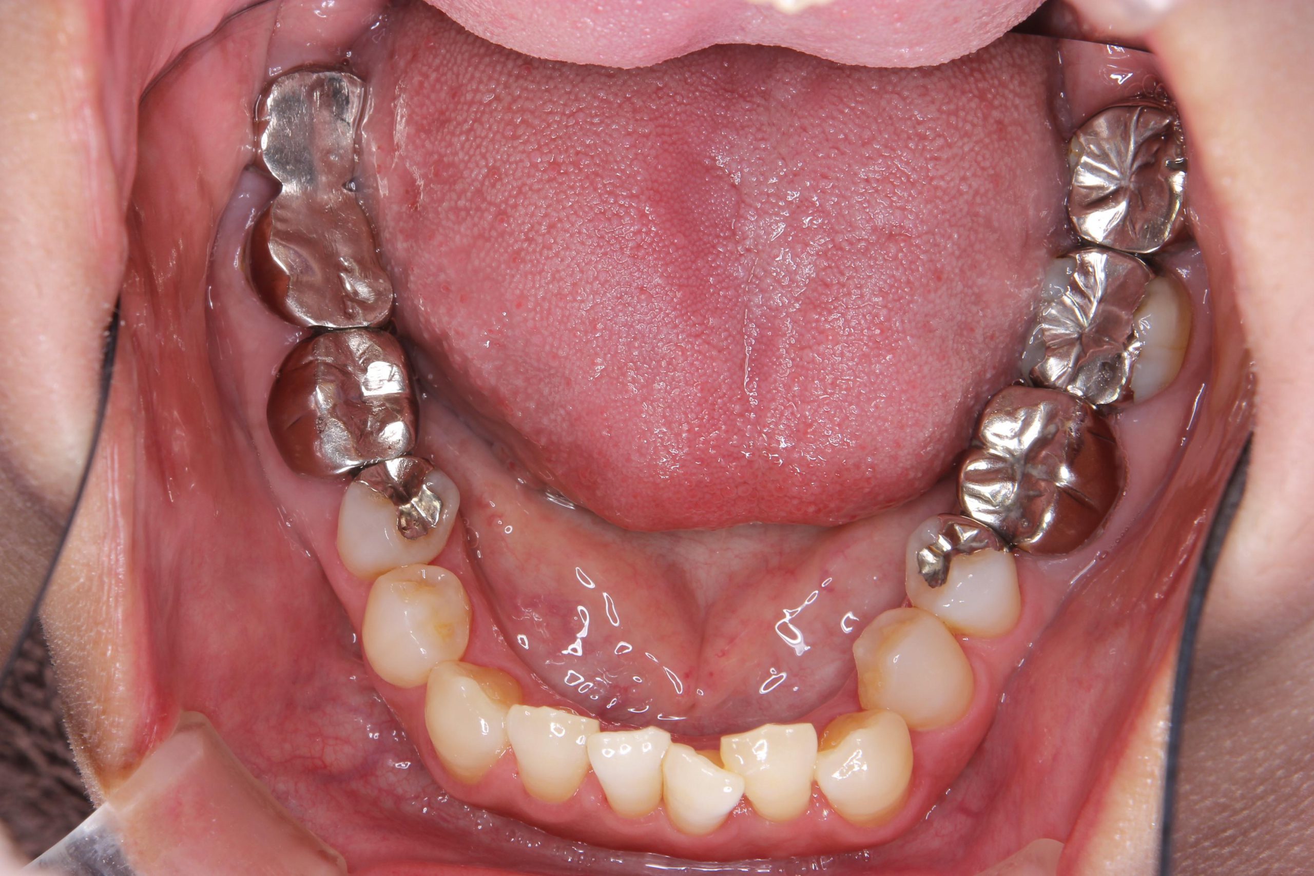 前 から 4 番目 の 歯 抜歯