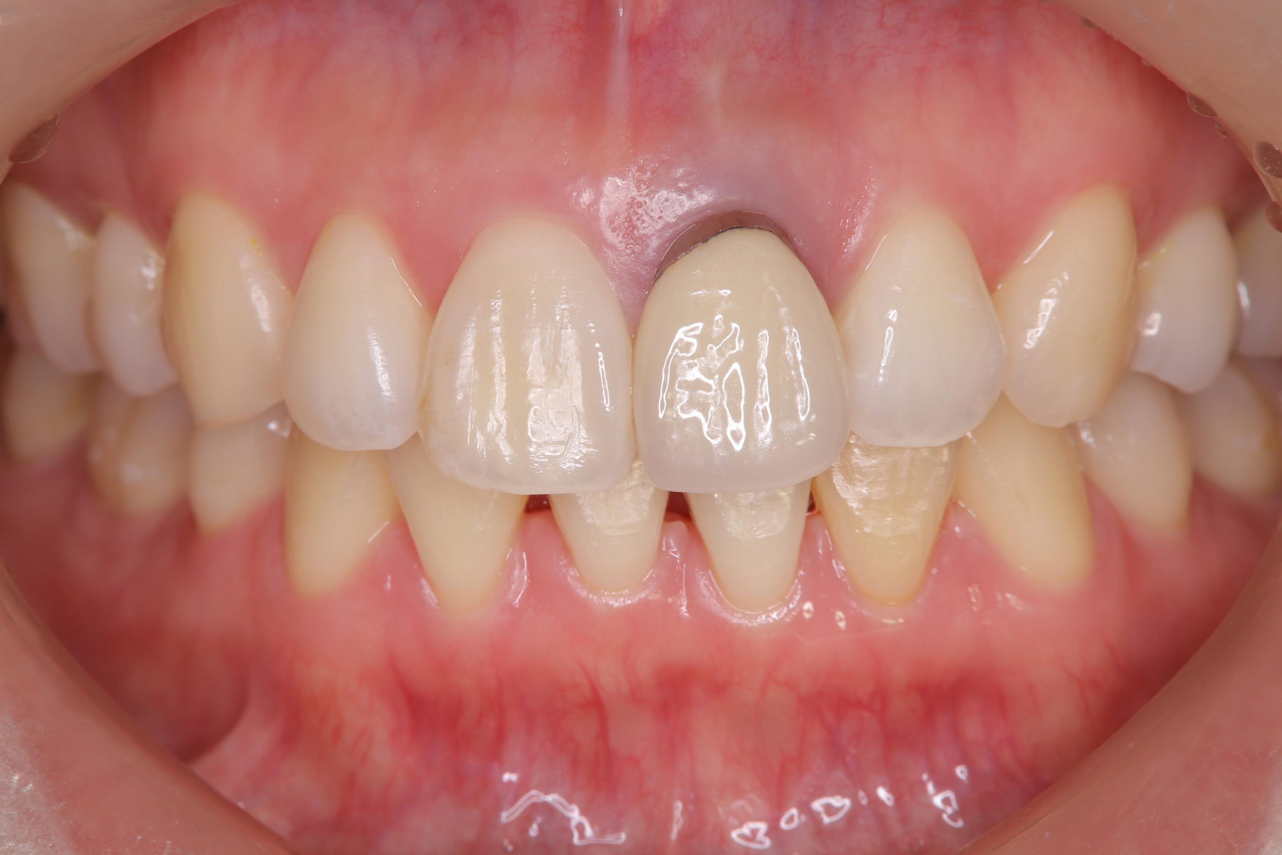 前歯 の 治療 セラミック