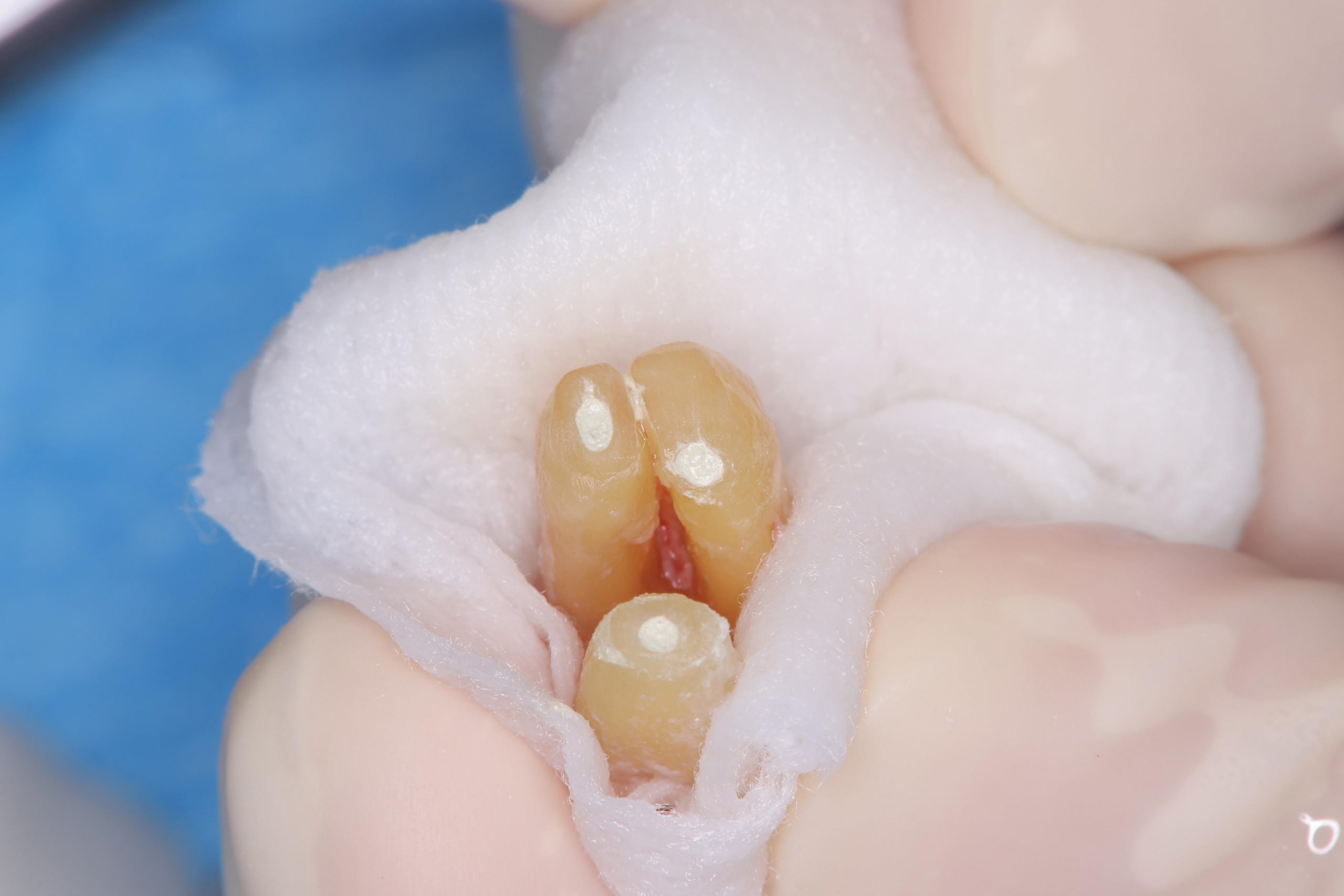 通常の根管治療では改善しない歯の再植 – 石神井公園 歯医者 – たけの 