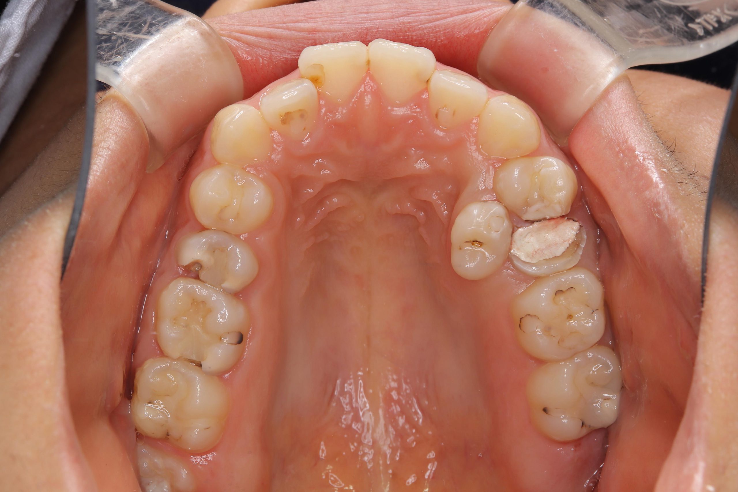 過剰歯の移植により、インプラントやブリッジを回避