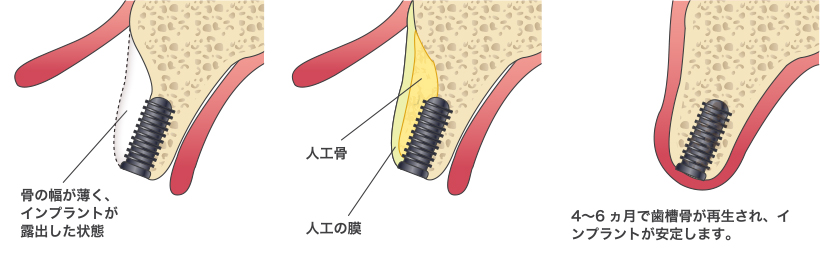 インプラント治療 骨の回復（GBR法） – 石神井公園 歯医者 – たけのうち歯科クリニック